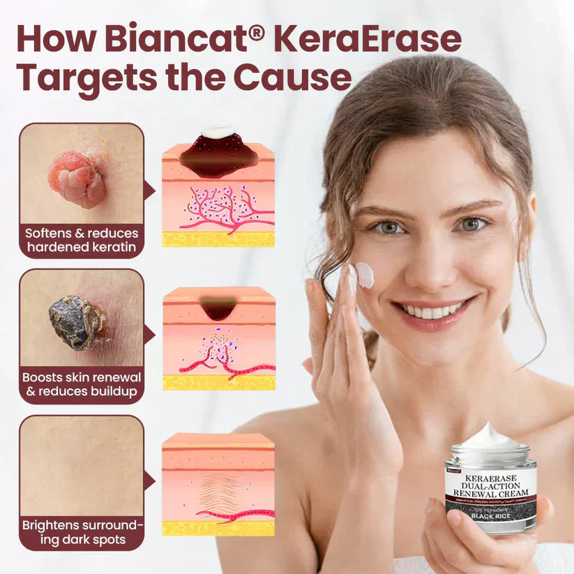 Biancat KeraErase Wart Remover Dual-Action Renewal Cream ( BUY 1 GET 1 FREE )