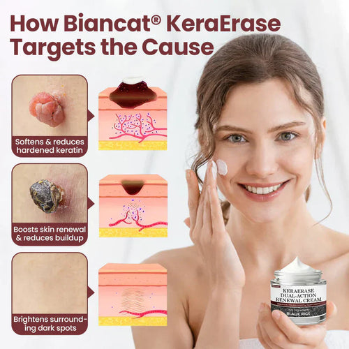 Biancat KeraErase Wart Remover Dual-Action Renewal Cream ( BUY 1 GET 1 FREE )
